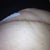 Two weeks post op