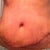 This is about ten days post surgery.  I just took the steristrips off, and you can see how swollen.  This looks VERY scary, but this is the worst that it has looked.  The lumpiness around the scar is what freaked me out the most.