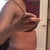 17 days PO (side view).  Swelling around my BB and in my pubic area.