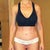 3 months post op. No scars are visible from the front or back when standing like this.  Amazing!
