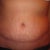 8 wks PO. Close up of scar and hematoma swelling. The scar on the hematoma side is still higher up than the right side but it has definitely come down since the first week.