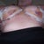 4 Days post op