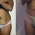 Photo on the left was taken on 9-10-11
photo on the right was taken 10-10-11
Surgery was done on 9-19-11
