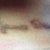 2 weeks and 3 days after 3rd treatment.  5 More treatments to go per our plan.