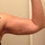 6 weeks post op, R arm