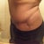 4 month scar - right side
