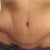4 month scar - front