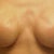450cc saline over muscle done in 2002, severe rippling