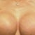 July 2011, 6 days post op, 700cc saline implants overfilled to 800 cc over muscle