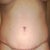 POD 22. Front side. Scar over pubic area is looking slightly better with silicone application