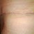 POD 22. Hip areas are both healing nicely, even though the ends of the incision are the most painful.