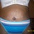 9 days postop I still have alot of stretch marks but extra skin is gone! I cant wait for the swelling to go down
