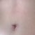 POD 14: My belly button glue has come off. There are still sutures at the top, I think when the swellings goes down it will start to sink in a bit.