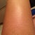 Post 3rd treatment- At maybe 90% reduction! Haven't shaved in 5 days!!! Yay! (Pardon the keratosis pilaris)