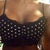 10 days post op. They look big because its a close up, but they aren't as big as they seem. The bralette is a little small but I like it for now because it keeps them in place.