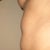 Before side abd 