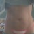 3 months post op 