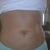 new stomach!!  :-)  3/08
