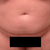 Front View - day of surgery. The doctor also took some fat from my pubic area.