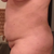 Side View - day of surgery.