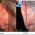 Fiances Ostoplasty before and after pics. Left ear. NO CHANGE! no cartlidge removed at all!
