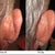 Fiances ostoplasty before and after pics. Right ear, skin pulled over 1-2cm, No cartlidge removed at all!