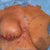 Half-done!  Just need to get the nipple-areola complex out and sew around the new areola.  Note the staples used both as temporary sutures in the breast, and as markings on my chest.