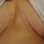 16 weeks po a better view of how well my scar gel worked.  I'm now using it on my entire BA scar