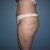 I am hoping that the areas on my thighs where I had the lipo will continue to smooth out.