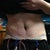 1 day post op front side standing up.