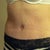 18 days PO; the lines are due to the binder being so tight, they are not actually scars like they may appear