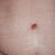 Close up of BB and incision week 2