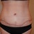 week 2 scars. Seroma causes the scar to float up on one side