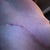 rev scar 9 wks post