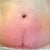Full scar close up at 12 weeks. Hate the T scar!  Oh well.