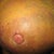 This shows the needle injections of the fat grafting.