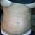 Day 10 see the lil lump.  uggggg