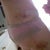 Lipo Bruising at Day 12