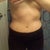 5 weeks post op, decided to take a pic with my work pants on, never been able to wear these pants and not have squishy fat hang over!
