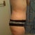 6 weeks post op