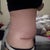 two weeks post op scar