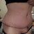 two weeks post op scar