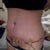 two weeks post op