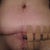 two weeks post op