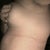 side view PO 10 days, still really swollen