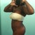 left side - 3 weeks post op