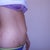 side view pre op belly