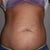 Pre op belly