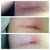 Right incision. 11 days, 14 days and 21 days post