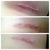 Left incision. 11,14 and 21 days post